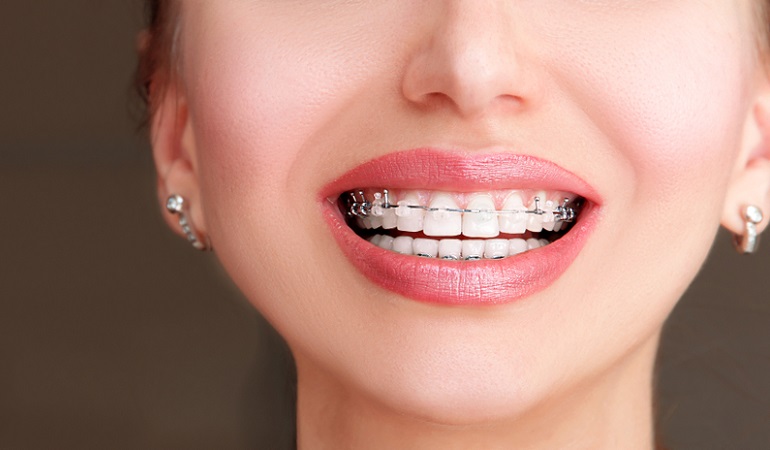 8 things you should know before getting braces