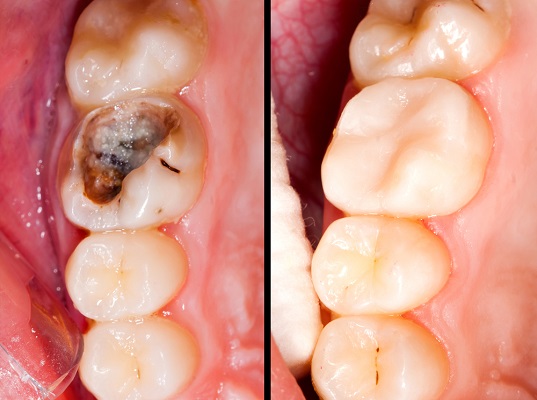 asthetic-filling-treatment-swargate