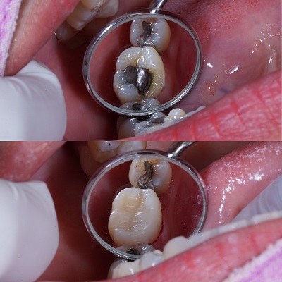 asthetic-filling-treatment