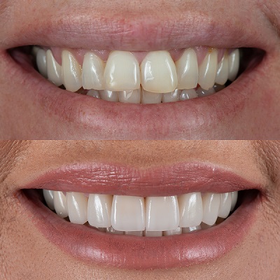 smile-makeover-treatment