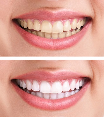 teeth-whitening